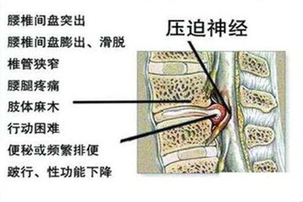 腰椎間盤突出困擾很多人,腰間盤突出壓迫神經這樣解決