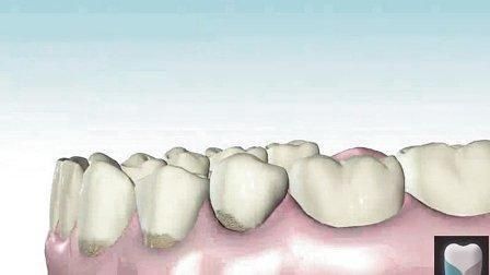 牙结石很臭怎么办?有3大危害!四招轻松去除