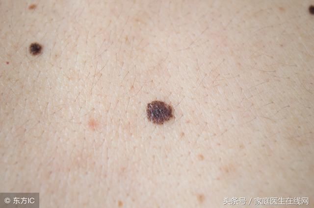 药水点痣好吗?皮肤科医生:祛痣还是要选择这一