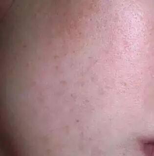 阿莫西林加上它,急速淡斑美白