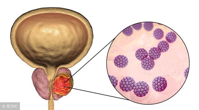 安阳男健医院:关于常见前列腺炎的问题,一次性