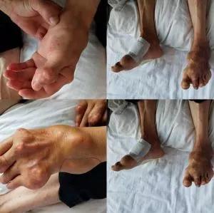 降尿酸药能溶解尿酸盐结晶、痛风石吗?(图3) 降尿酸药能溶解尿酸盐结晶、痛风石吗?(图3)