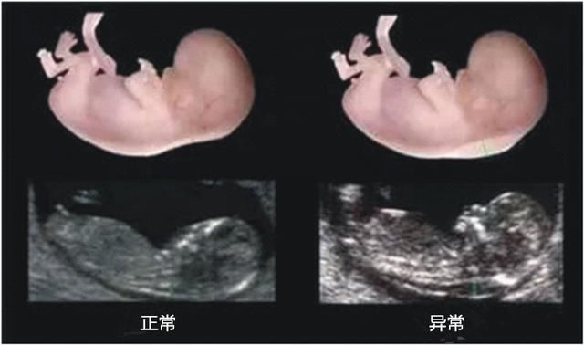 NT检查胎儿第一次排畸B超,很多准妈妈竟认为