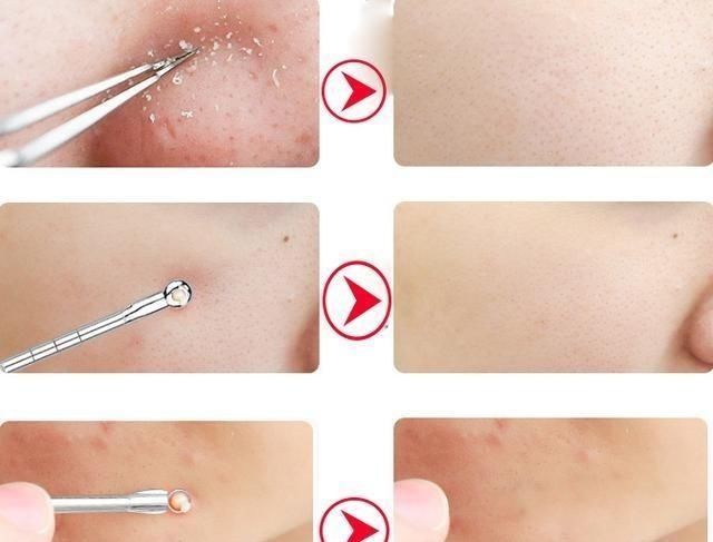 痘痘里面挤出来的白色东西是什么?教你挤痘不留疤痕的五大妙招