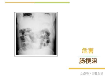 肚子疼,恶心呕吐还发烧,家长警惕孩子是阑尾炎