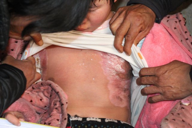 9岁女童全身大面积烧伤 最大心愿是能够上学