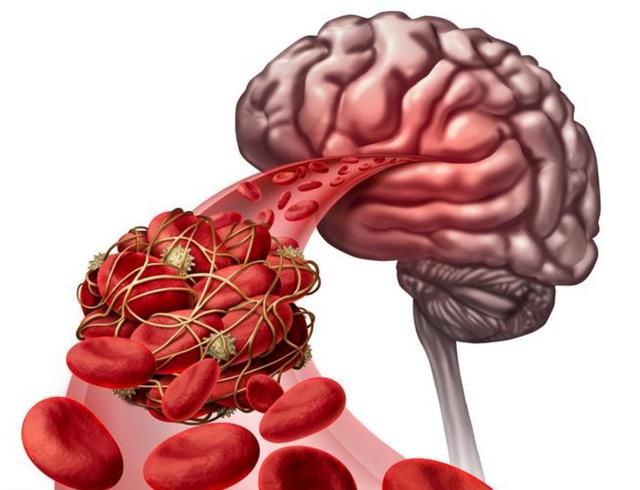 脑血管堵塞,脑梗马上来,冰箱里的1种豆,防脑梗