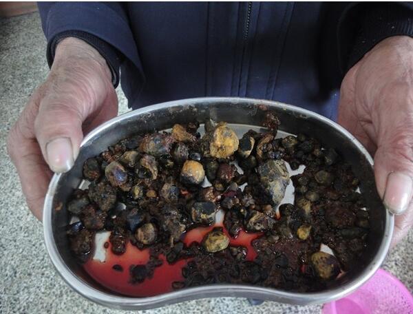 胆结石手术可以报销吗 北京医保胆结石