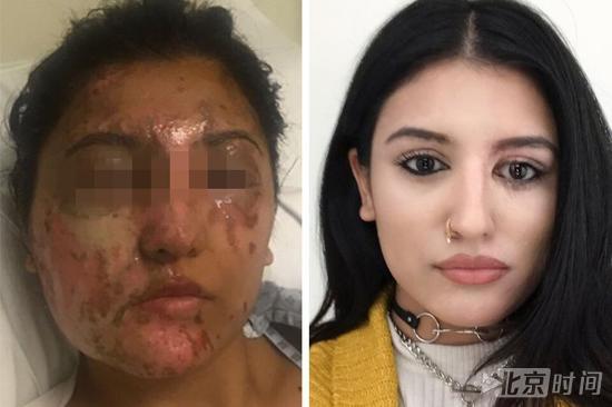 21岁女生遭人泼硫酸严重毁容 4个月后奇迹恢复美貌 21岁女生遭人泼硫酸严重毁容 4个月后奇迹恢复美貌