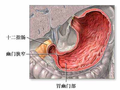 少数婴儿天生胃幽门环肌肥厚,导致胃幽门官腔狭窄