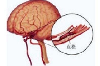 服用阿司匹林预防脑血栓,怎样服药更安全有效