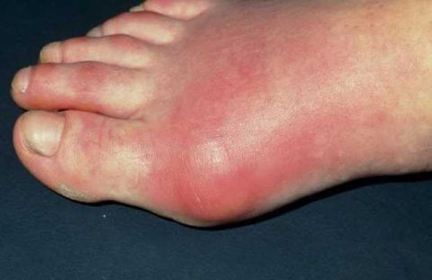 喝酒为什么会导致尿酸升高痛风发作呢?这是酒