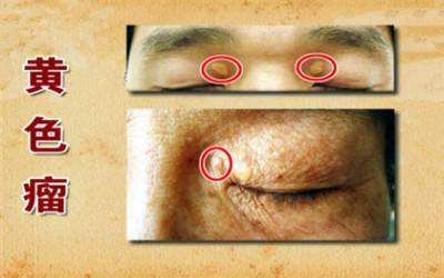 皮肤上出现这些标记,暗示你血脂高了,快查查,不