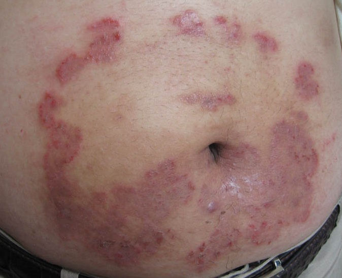 体癣治疗应该怎样有效,教你最有效的方法