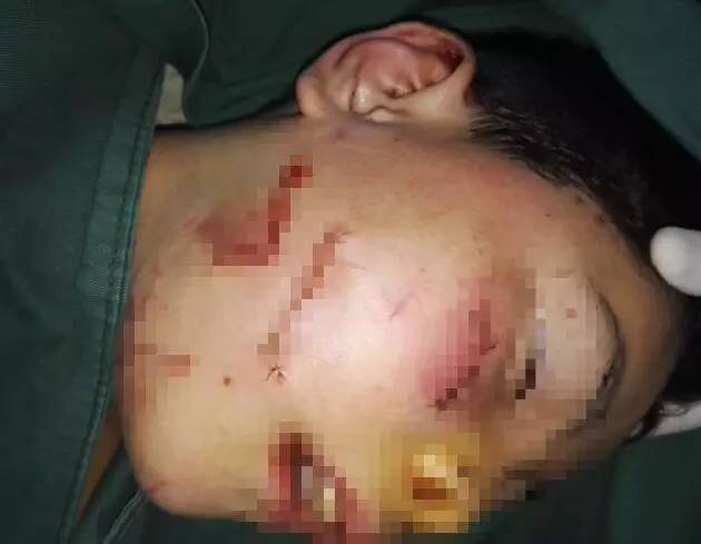 10岁男孩遭邻居毒手 面部砍伤9处舌头被割断 10岁男孩遭邻居毒手 面部砍伤9处舌头被割断