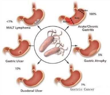 往开水里悄悄放一点,杀死了幽门螺旋杆菌,赶跑