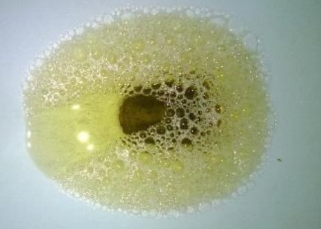 尿液中泡沫增多是怎么回事?泡沫尿是不是肾不