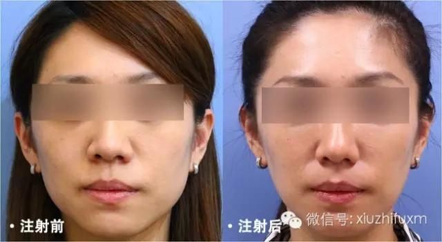 拔智齿瘦脸,到底是能?还是不能?