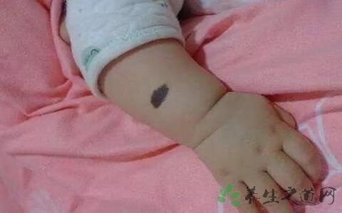 黑色素瘤能治愈吗