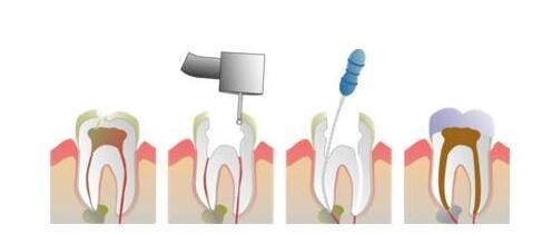 治疗孩子烂牙太凶的根管治疗是咋做的呢?