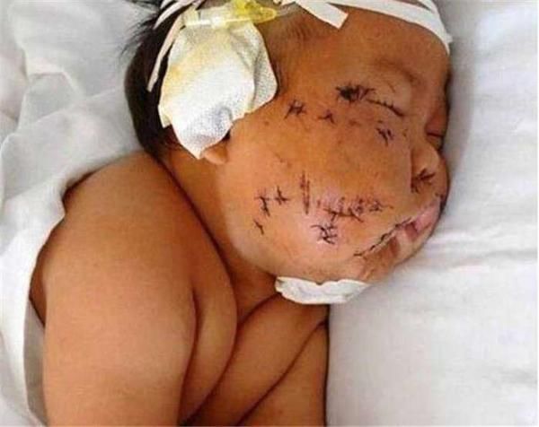 6个月宝宝吃奶咬疼妈妈,她把宝宝脸刺毁容,妈妈:生他就是个错