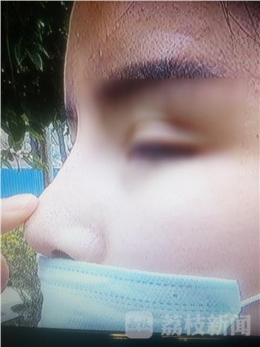荔枝监督:隆鼻半年后 鼻梁根部为何有晃动的感觉?