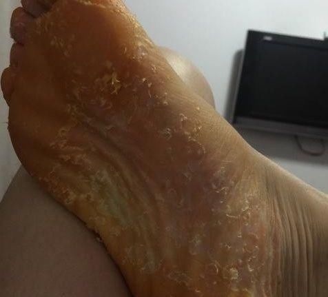 如何有效去脚气8年脚气尴尬难治?麻之菜脚气