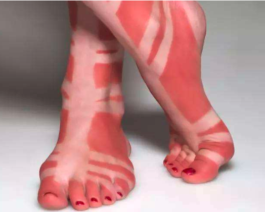 皮肤晒伤后出现白块,重现自信的小窍门