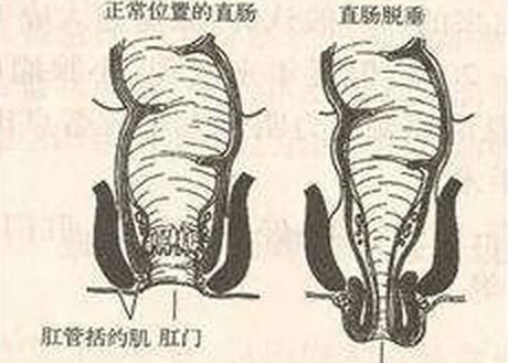 2月大宝宝突然重度脱肛,得知原因后妈妈当场