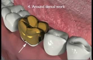 天天刷牙还满口烂牙?这4个位置没注意,牙齿算