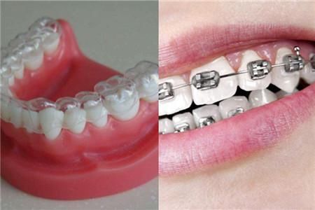 【图】矫正牙齿会改变脸型吗 带你了解真相