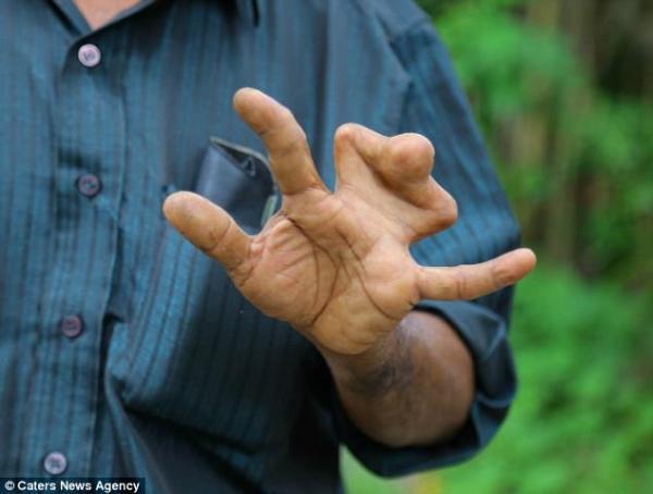 印度一家族140人有蹼状指 代代遗传拒绝手术 印度一家族140人有蹼状指 代代遗传拒绝手术