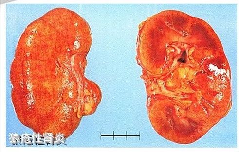 肾内科主任:尿毒症是怎么引起的?这7种病会悄