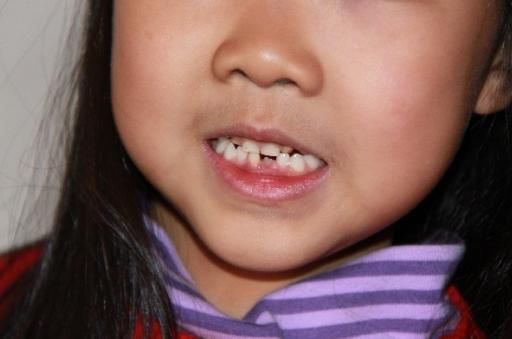 5岁换牙是早熟吗?儿童一般从几岁换牙?