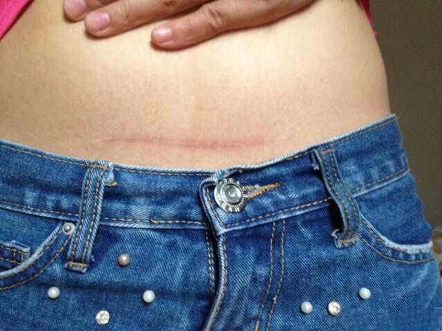 女人一生可以剖腹产几次?看完了扎心