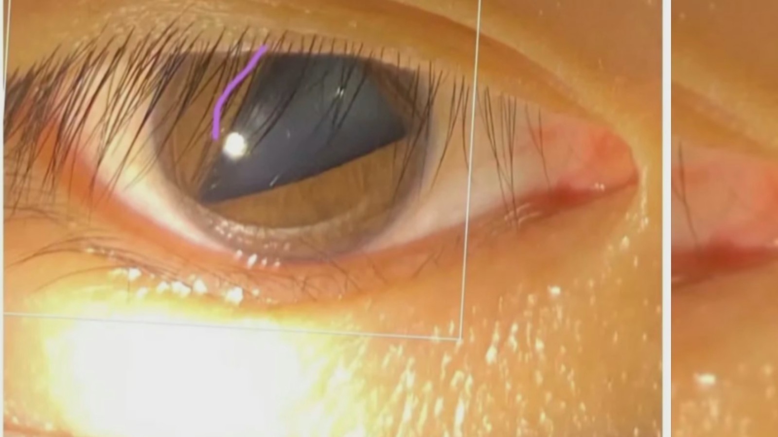 新闻早知道丨瞳孔突然变成三角形或心形 竟然是这个原因 新闻早知道丨瞳孔突然变成三角形或心形 竟然是这个原因