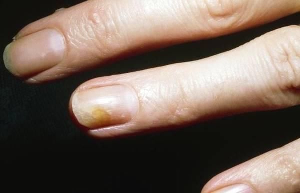 如果你的指甲变成这样,不是大病就是癌,最好上医院检查一下!