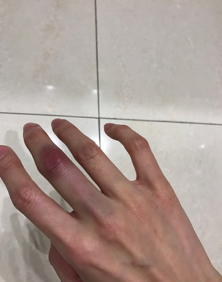 周丽淇演戏投入误伤自己 手上膝盖瘀伤惨不忍睹