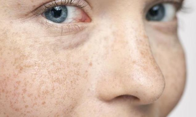 脸上的黑色素多?再不排除,小心很快堆积成色斑