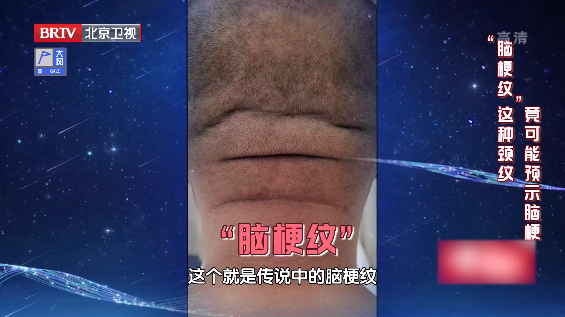 大医生说：警惕！！这种颈纹，竟可能预示脑梗