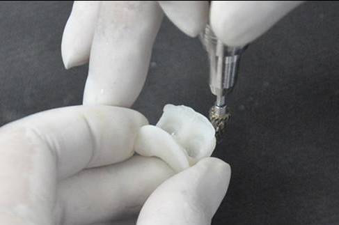 备牙后不戴临时牙是给自己找麻烦