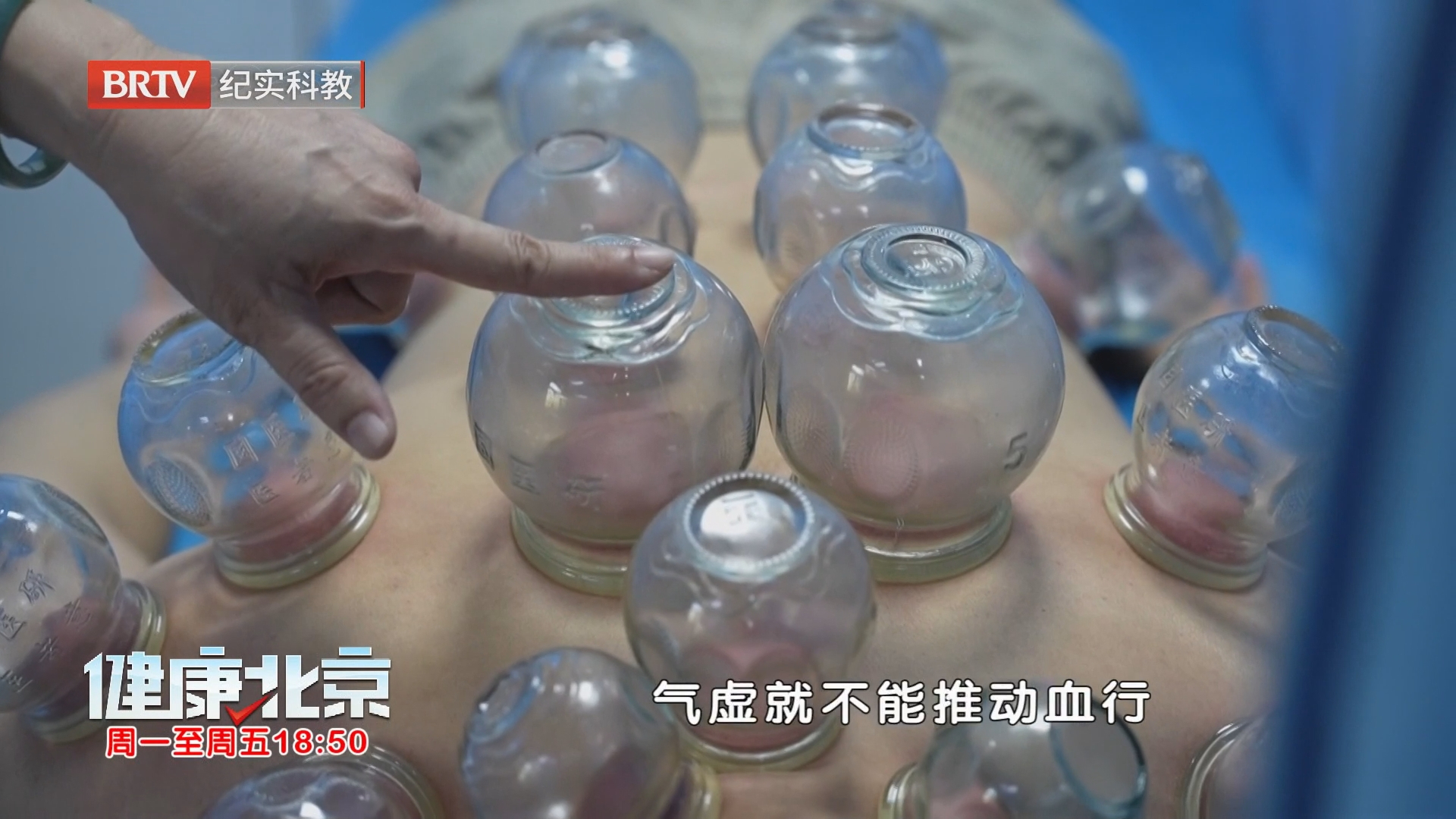 巧用拔罐+针灸 患者头痛症状明显减轻