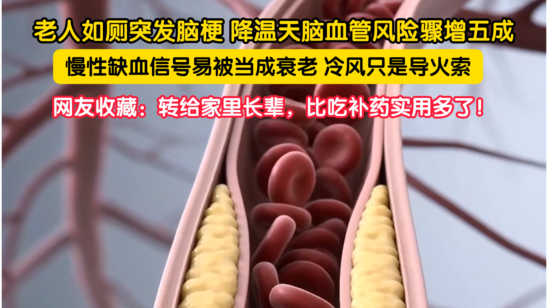 老人如厕突发脑梗 降温天脑血管风险骤增五成