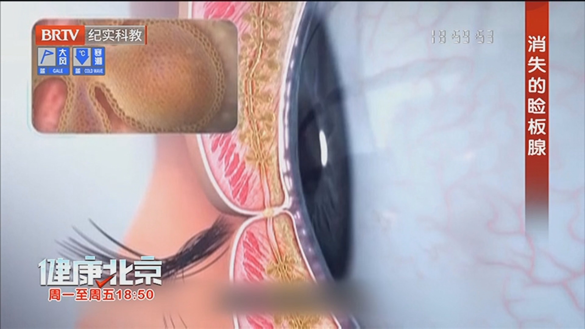 《健康北京》20260205别让干眼模糊生活的诗意