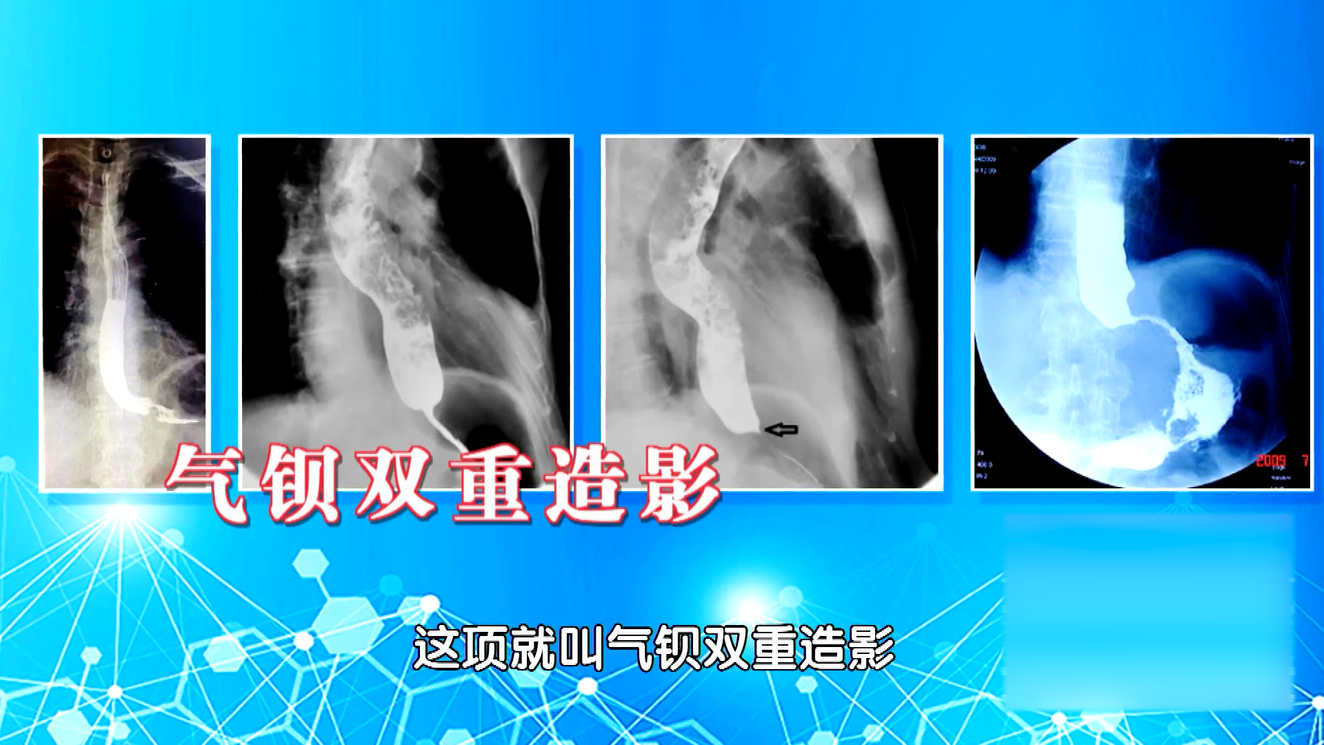 除了内镜检查，钡餐造影、气钡双重造影也能早发现食管胃交界癌