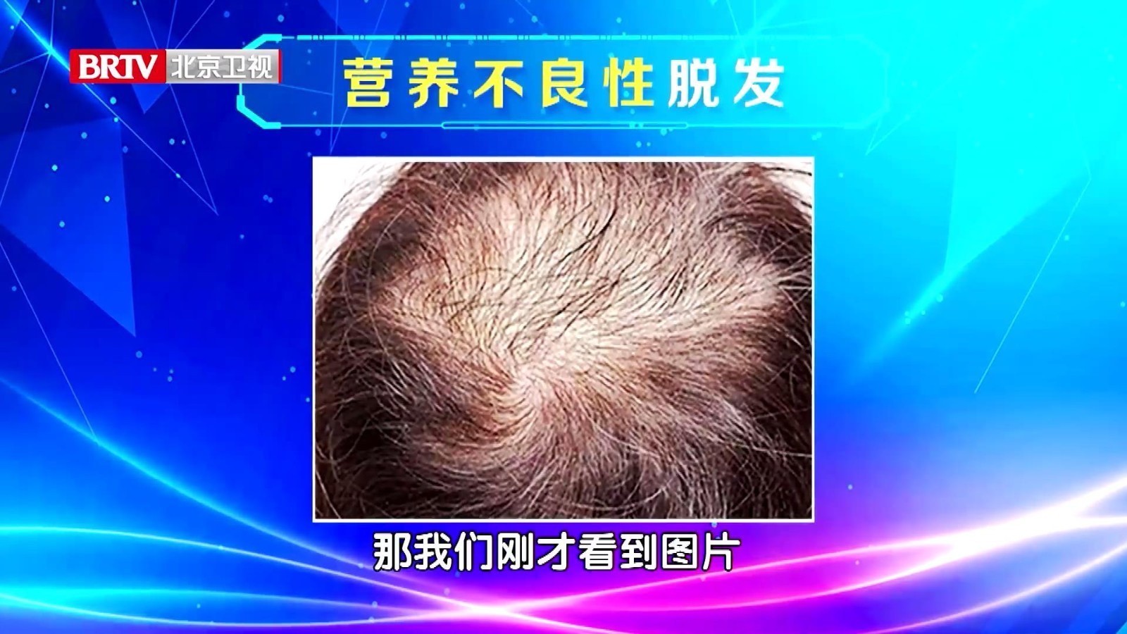 休止期脱发又称营养不良性脱发，怎么分辨自己是不是休止期脱发呢？