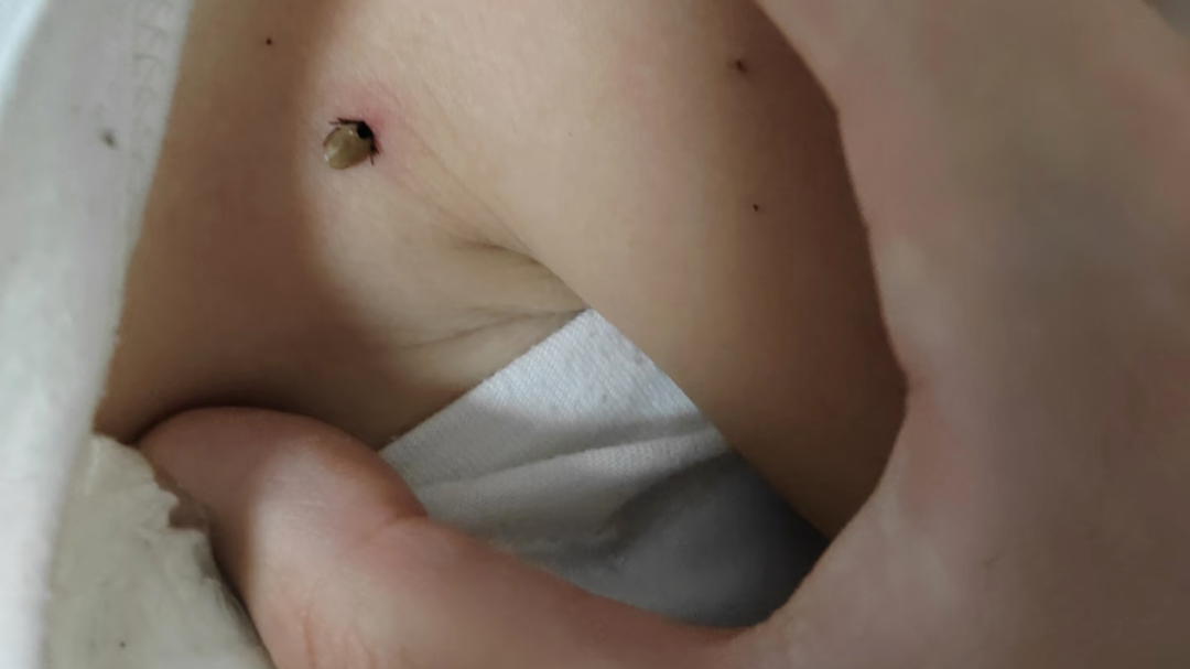 小心!北京多人被叮咬,已有死亡病例!专家紧急提醒 小心!北京多人被叮咬,已有死亡病例!专家紧急提醒