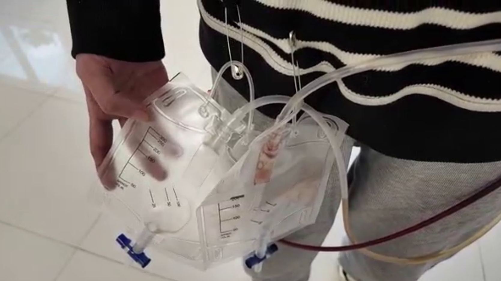 先天性胆管扩张带管 7 年不敢抱娃！医学突破让她重获新生