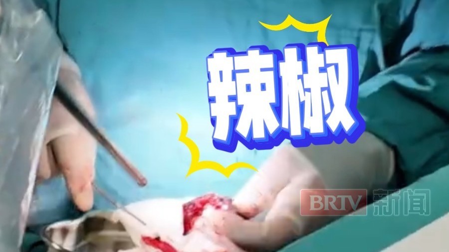 离谱!70岁大爷肺上长“肿瘤”,家人甚至都做好了最坏的打算,手术时医生一刀下去发现原来是个辣椒 离谱!70岁大爷肺上长“肿瘤”,家人甚至都做好了最坏的打算,手术时医生一刀下去发现原来是个辣椒