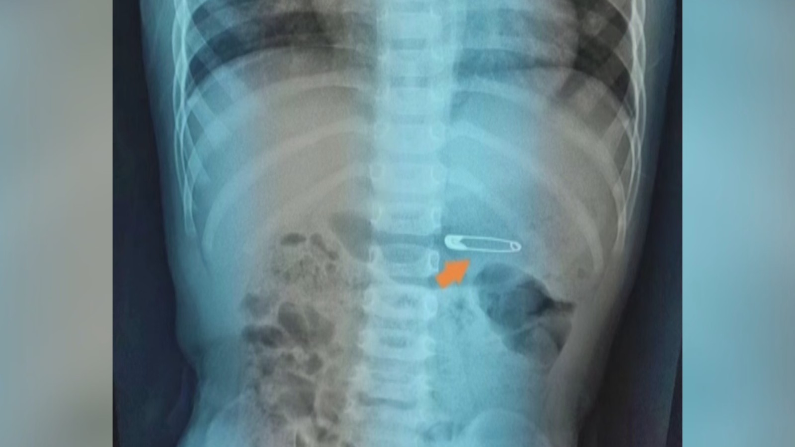 别针竟被一岁半宝宝吞入腹中!医生用一招取出 别针竟被一岁半宝宝吞入腹中!医生用一招取出